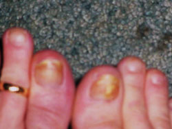 Tipična gljivična infekcija noktiju, slika prije tretmana koloidnim srebrom