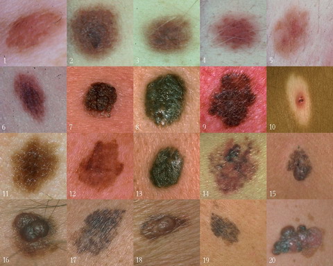 Različite vrste melanoma - raka kože. Hoćemo li mi konačno saznati istinu kako i zašto nastaje rak kože?