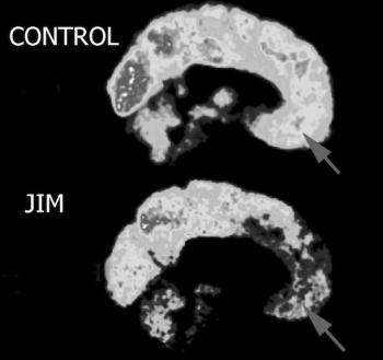 Na donjoj slici vidite mozak Jima Fallona, u prednjem režnju gotovo i nema aktiovnosti.
