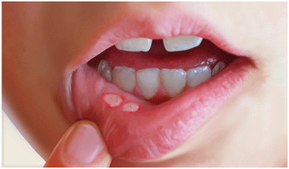 Upale sluzokože usta - laščerice - su često uzrokovane glutenom.